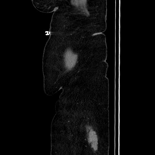 Acute diverticulitis - transverse colon (Radiopaedia 87063-103327 Sagittal C+ portal venous phase 39).jpg