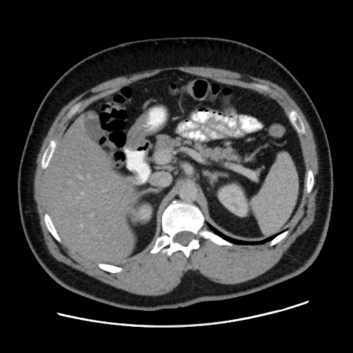 Acute diverticulitis with localized perforation (Radiopaedia 41296-44113 Axial C+ portal venous phase 28).jpg