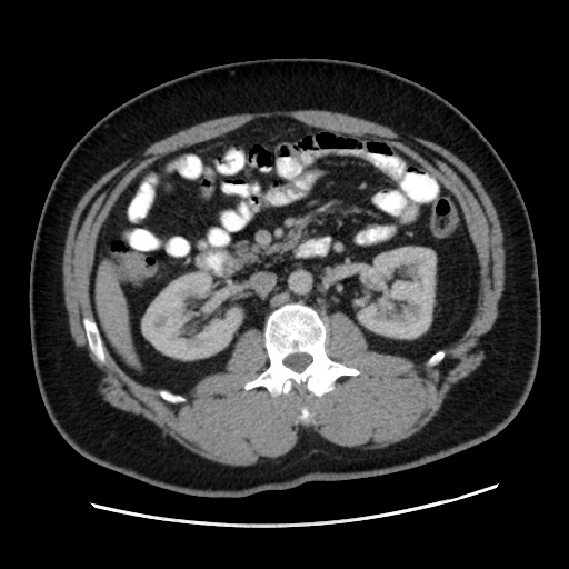 Acute diverticulitis with localized perforation (Radiopaedia 41296-44113 Axial C+ portal venous phase 39).jpg