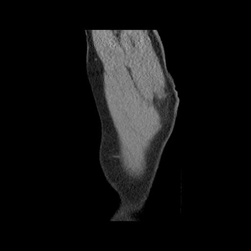 Acute epicardial fat necrosis (Radiopaedia 42327-45440 Sagittal C+ CTPA 73).jpg