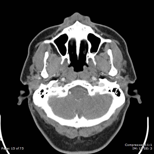 Acute epiglottitis (Radiopaedia 54375-60590 Axial C+ arterial phase 15).jpg