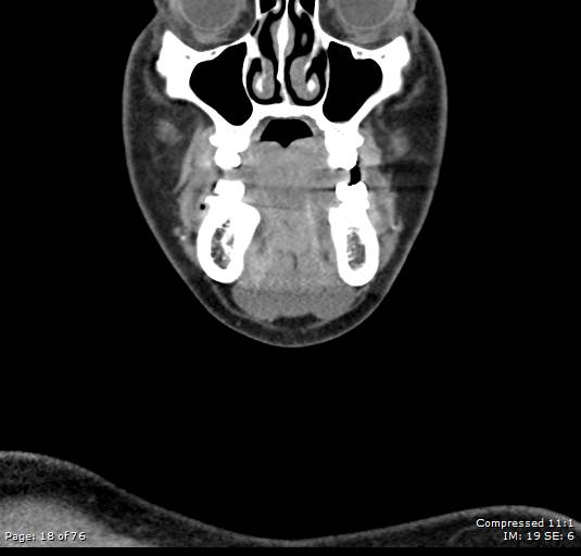 Acute epiglottitis (Radiopaedia 54375-60590 Coronal C+ arterial phase 18).jpg