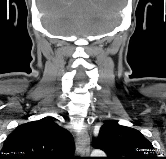 Acute epiglottitis (Radiopaedia 54375-60590 Coronal C+ arterial phase 52).jpg