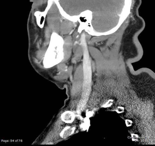 Acute epiglottitis (Radiopaedia 54375-60590 Sagittal C+ arterial phase 54).jpg
