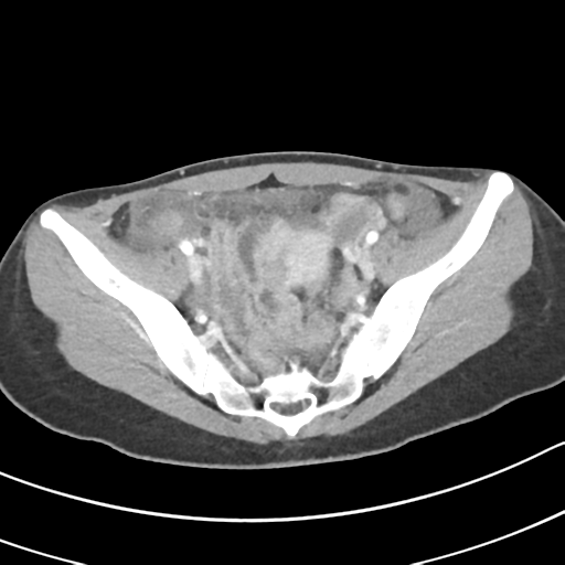 Acute gangrenous appendicitis with perforation (Radiopaedia 40152-42662 Axial C+ portal venous phase 59).png