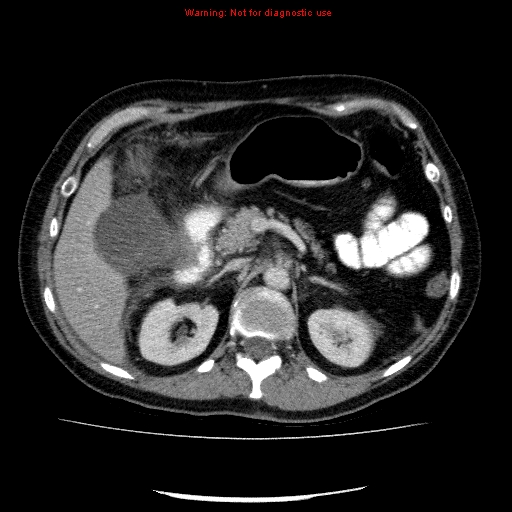 Acute gangrenous cholecystitis (Radiopaedia 10123-10661 Axial C+ portal venous phase 33).jpg