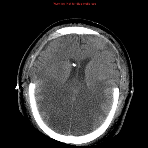 Acute hemorrhagic leukoencephalitis (Radiopaedia 14076-43697 Axial non-contrast 31).jpg
