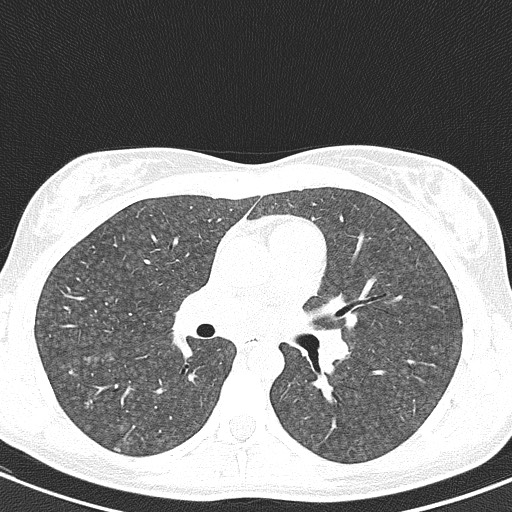 File:Acute hypersensitivity pneumonitis (Radiopaedia 85293-100870 Axial lung window 54).jpg