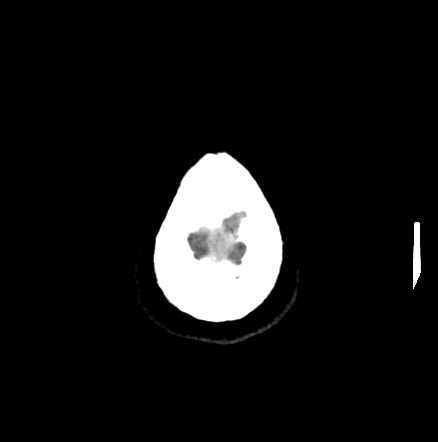 Acute internal carotid artery dissection (Radiopaedia 53541-59558 Axial non-contrast 60).jpg