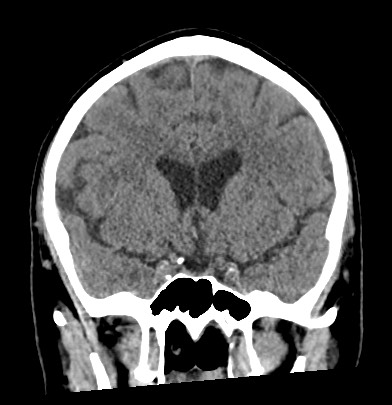 File:Acute internal carotid artery dissection (Radiopaedia 53541-59558 Coronal non-contrast 32).jpg