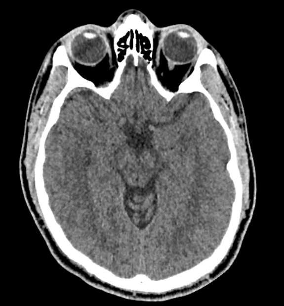 Acute ischemic stroke - posterior circulation territory (Radiopaedia 77670-89881 non-contrast 36).jpg