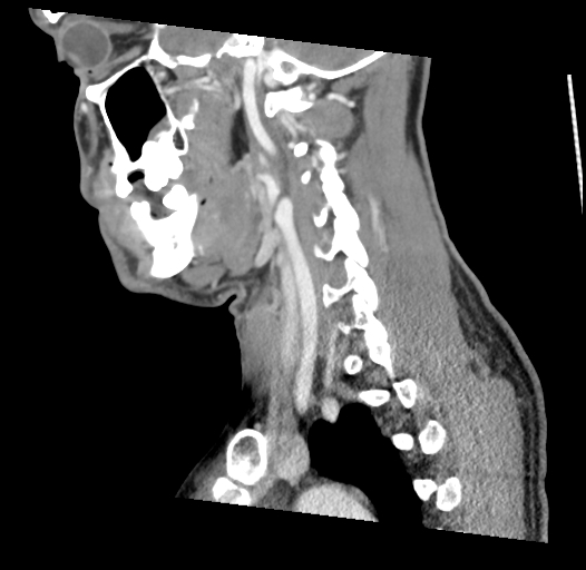 Acute longus colli calcific tendinitis (Radiopaedia 72495-83036 Sagittal C+ arterial phase 20).jpg