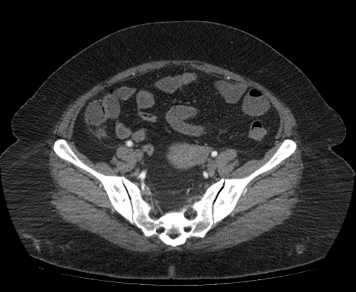 Acute mesenteric ischemia (Radiopaedia 80029-93316 Axial C+ arterial phase 103).jpg