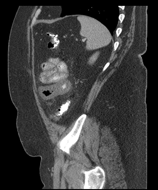 Acute mesenteric venous ischemia (Radiopaedia 46041-50383 Sagittal C+ portal venous phase 95).jpg