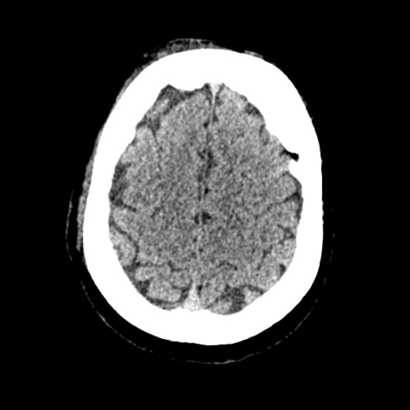 Acute middle cerebral artery territory infarct (Radiopaedia 52380-58283 Axial non-contrast 88).jpg