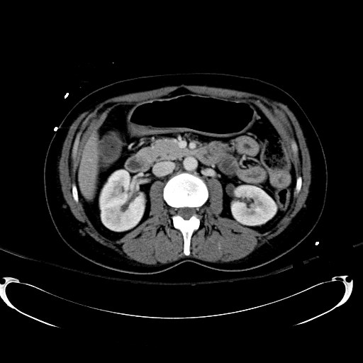 File:Acute myocardial infarction in CT (Radiopaedia 39947-42415 Axial C+ portal venous phase 54).jpg