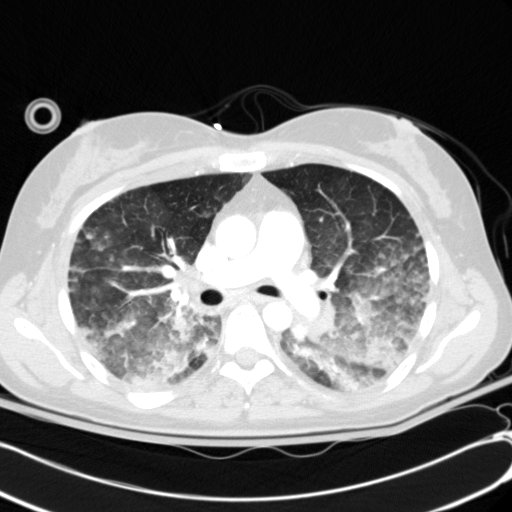 Acute myocardial infarction in CT (Radiopaedia 39947-42415 Axial lung window 53).jpg