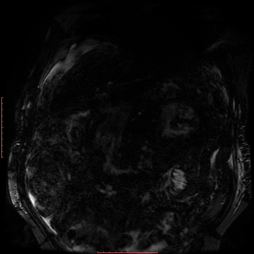 File:Acute necrotizing pancreatitis (Radiopaedia 28194-28448 Coronal MRCP 75).jpg