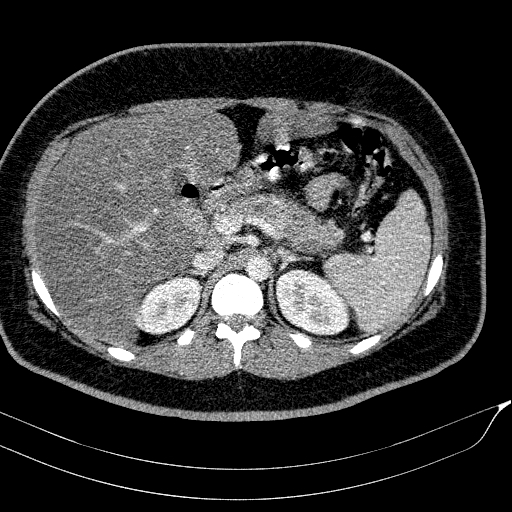 Acute on chronic pancreatitis (Radiopaedia 80902-94423 Axial C+ portal venous phase 49).jpg