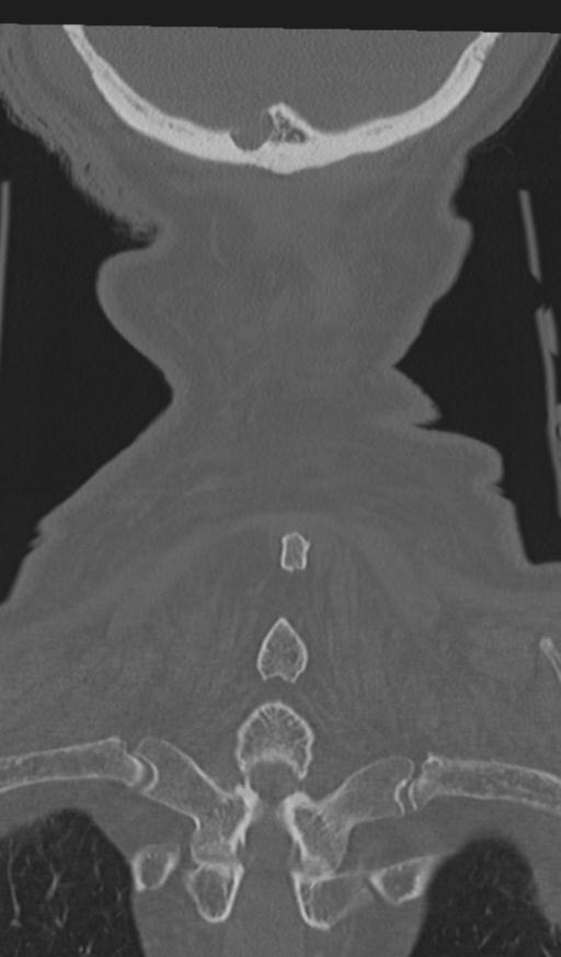 Acute on chronic subdural hematoma and thoracic vertebral injury in a multitrauma patient (Radiopaedia 31698-32619 Coronal bone window 63).jpg