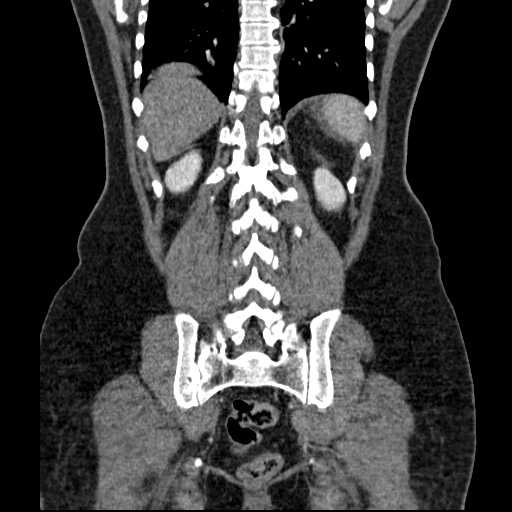 File:Acute pancreatitis (Radiopaedia 20829-20744 Coronal C+ portal venous phase 43).jpg
