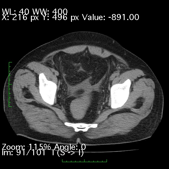 Acute pancreatitis (Radiopaedia 34043-35276 Axial non-contrast 91).jpg