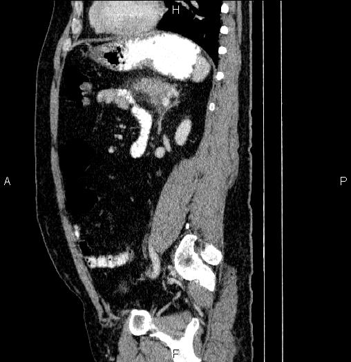 Acute pancreatitis (Radiopaedia 85390-101010 Sagittal C+ portal venous phase 68).jpg