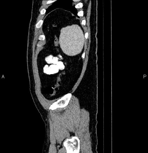 Acute pancreatitis (Radiopaedia 85390-101010 Sagittal C+ portal venous phase 95).jpg