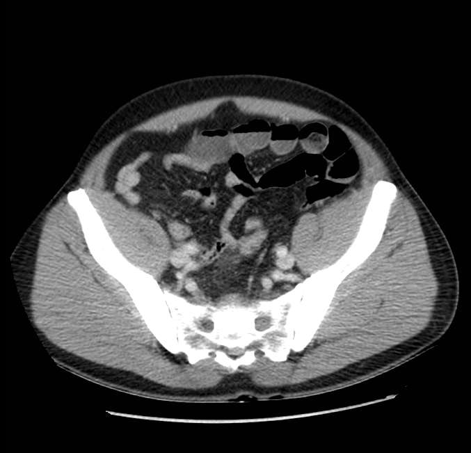 Acute pancreatitis - Balthazar E (Radiopaedia 23080-23110 Axial C+ portal venous phase 58).jpg