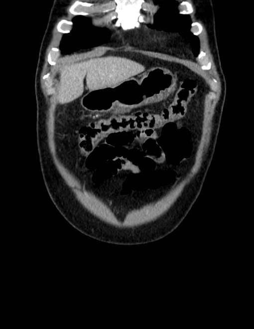 Acute pancreatitis - Balthazar E (Radiopaedia 23080-23110 Coronal C+ portal venous phase 8).jpg