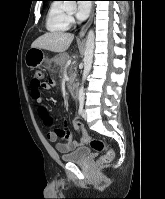 Acute pancreatitis - Balthazar E (Radiopaedia 23080-23110 Sagittal C+ portal venous phase 51).jpg