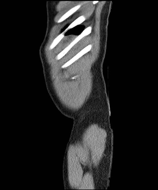 Acute pancreatitis - Balthazar E (Radiopaedia 23080-23110 Sagittal C+ portal venous phase 99).jpg