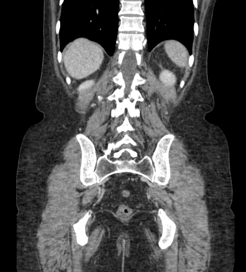 Acute pancreatitis - Balthazar E - post ERCP (Radiopaedia 27562-27772 Coronal C+ portal venous phase 71).png