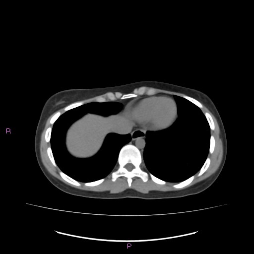 Acute pancreatitis secondary to stone at minor papilla and pancreatic divisum (Radiopaedia 76570-88333 Axial non-contrast 7).jpg