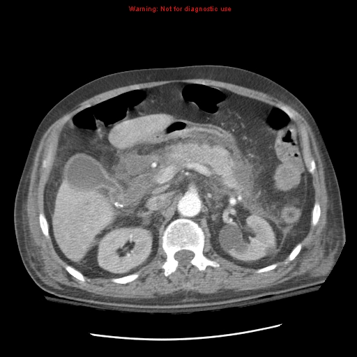 Acute pancreatitis with incidental pancreatic lipoma (Radiopaedia 10190-10730 Axial C+ arterial phase 37).jpg