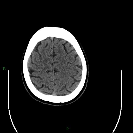 Acute posterior cerebral artery territory infarct (Radiopaedia 79329-92393 Axial non-contrast 91).jpg