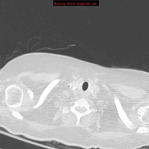 File:Acute pulmonary embolism (Radiopaedia 13286-13289 B 1).jpg