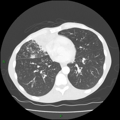 Acute right lung abscess (Radiopaedia 34806-36258 Axial lung window 120).jpg