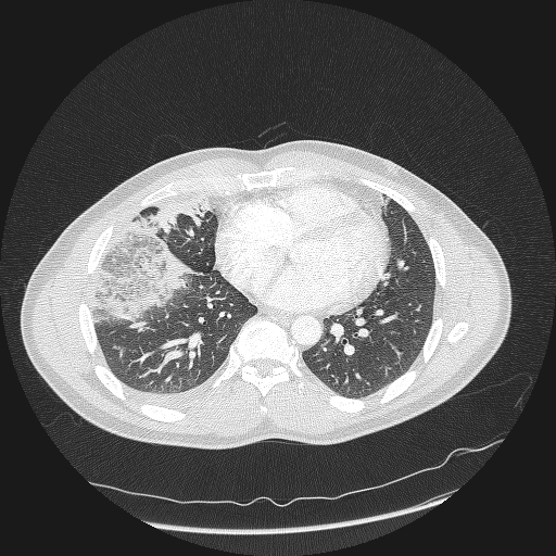 Acute segmental pulmonary emboli and pulmonary infarction (Radiopaedia 62264-70444 Axial lung window 122).jpg