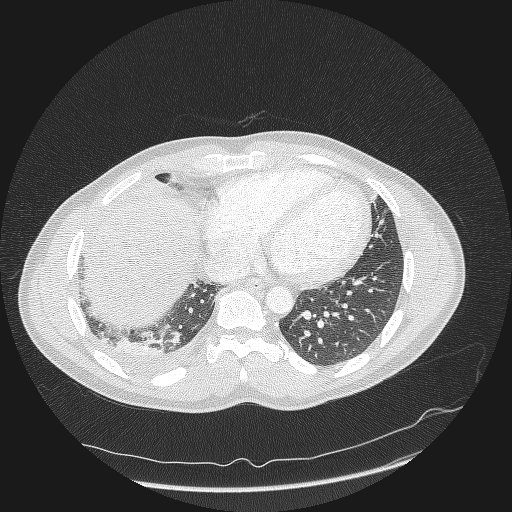 Acute segmental pulmonary emboli and pulmonary infarction (Radiopaedia 62264-70444 Axial lung window 139).jpg