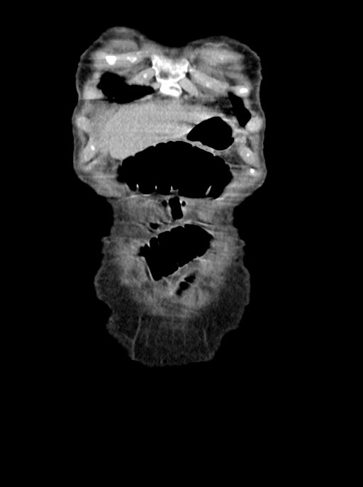 Acute small bowel (ileal) volvulus (Radiopaedia 71740-82139 Coronal C+ portal venous phase 12).jpg