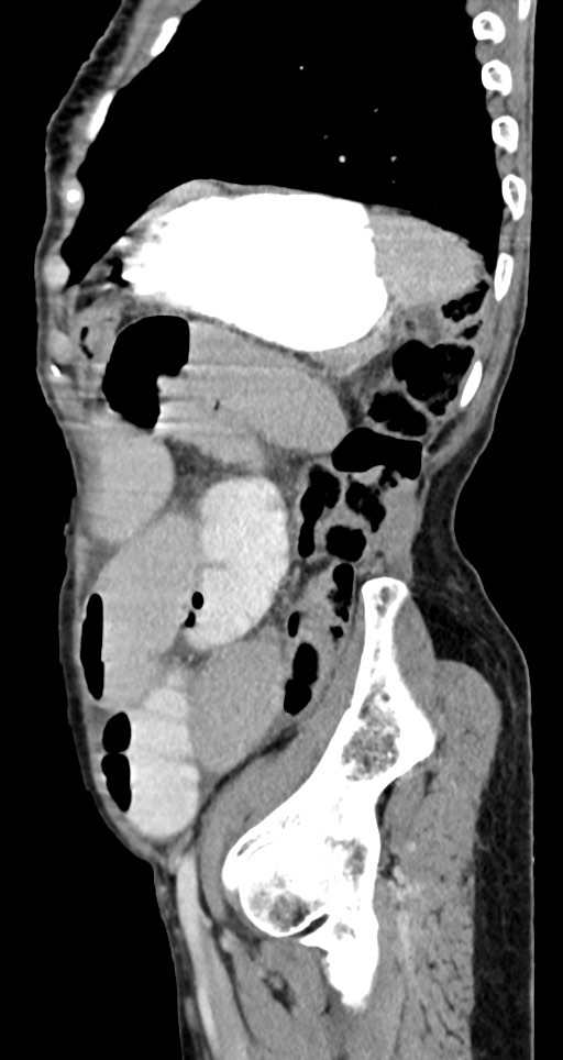 Acute small bowel (ileal) volvulus (Radiopaedia 71740-82139 Sagittal C+ portal venous phase 50).jpg