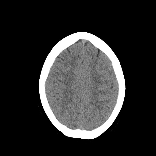 Acute subarachnoid hemorrhage and accessory anterior cerebral artery (Radiopaedia 69231-79008 Axial non-contrast 40).jpg