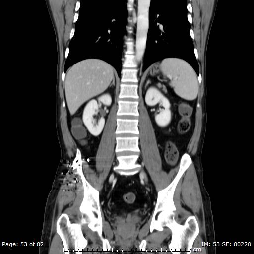 Acute superior mesenteric artery occlusion (Radiopaedia 43636-47060 Coronal C+ portal venous phase 38).jpg