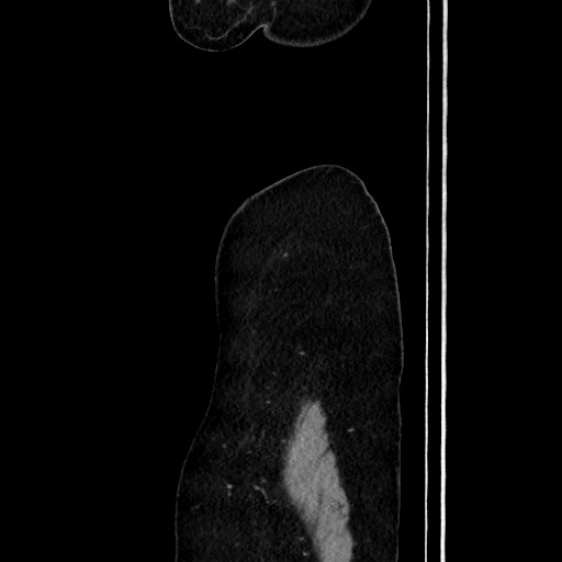 Acute uncomplicated appendicitis (Radiopaedia 73704-84499 Sagittal C+ portal venous phase 32).jpg