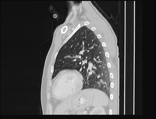 Addison disease (Radiopaedia 49318-54412 Sagittal lung window 18).jpg