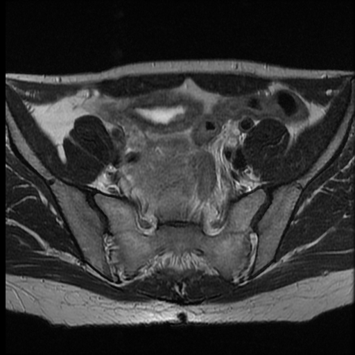 File:Adenocarcinoma arising in a urethral diverticulum (Radiopaedia 12400-12657 Axial T2 2).jpg