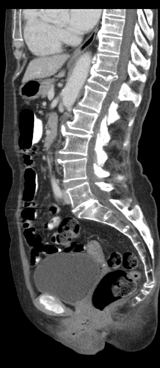 Adenocarcinoma of cecum (Radiopaedia 59222-66549 Sagittal C+ portal venous phase 43).jpg