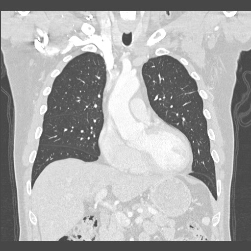 Adenocarcinoma of the lung (Radiopaedia 59871-67325 Coronal lung window 19).jpg
