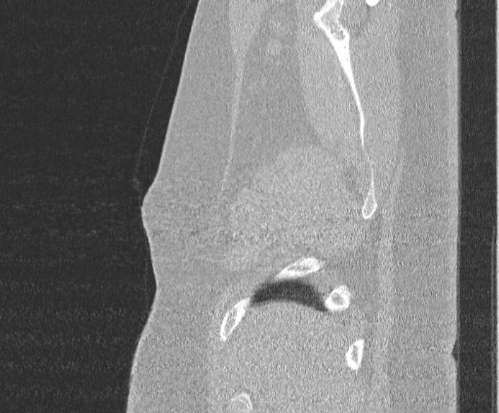 File:Adenoid cystic carcinoma of the trachea (Radiopaedia 49042-54137 Sagittal lung window 29).jpg